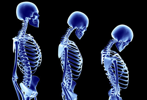 Usia Muda Bisa Kena Osteoporosis