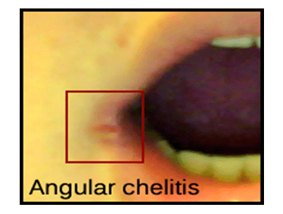 Penyakit Angular Cheilitis