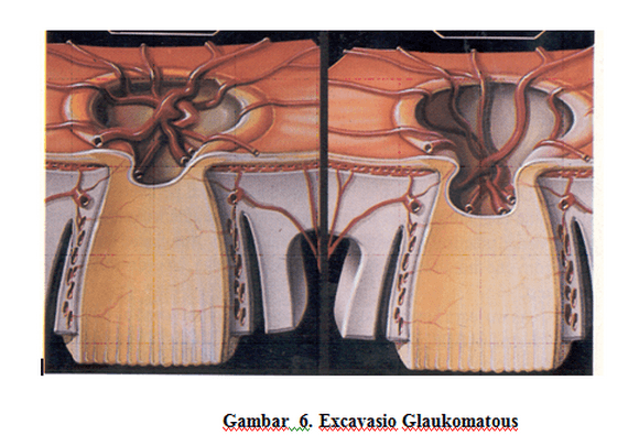 Gambar Excavasio Glaukomatous