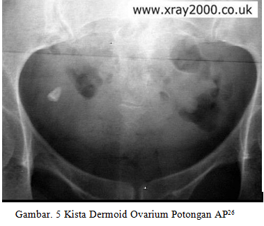 Gambaran Radiologis Kista Ovarium dari Foto Polos Pelvis