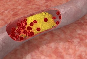 Cara Mencegah Kolesterol dan Asam Urat