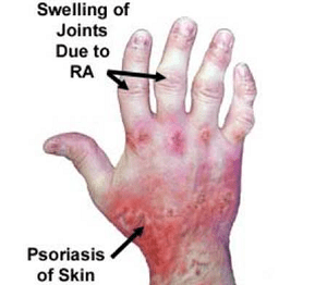 Mengenal Lebih Dekat Apa Itu Psoriatic Arthritis