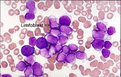 Leukemia limfositik akut