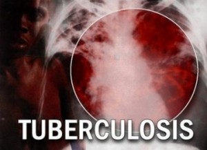 10 fakta penting mengenai tuberkulosis