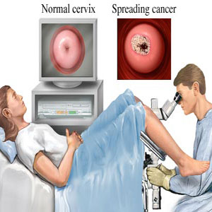 Diagnosa pada Kanker Serviks
