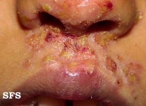 Penyakit Impetigo 