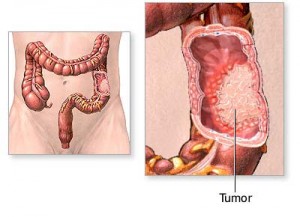 Penyakit Kanker Usus 