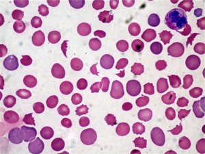 Thrombotic Thrombocytopenic Purpura