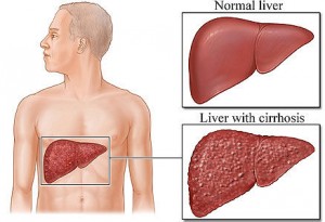 Hepatitis C