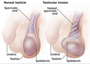 Penyakit Testicular Torsion atau Torsi Testis