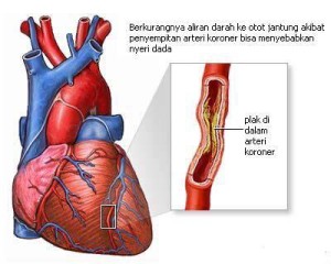 Informasi Penyakit Jantung Koroner