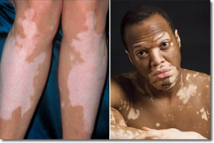 Penyakit Vitiligo Menyebabkan Kulit Manusia Berubah