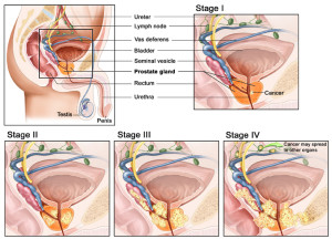 Stadium Kanker Prostat Pria