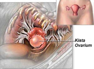 Macam-Macam Kista Ovarium