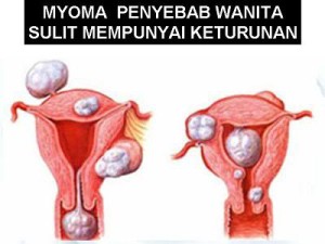 Penyakit Miom Pada Wanita