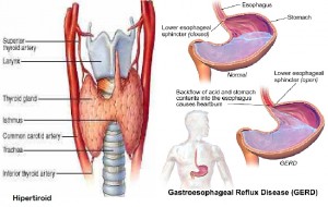 perbedaan-antara-gerd-dengan-hipertiroid